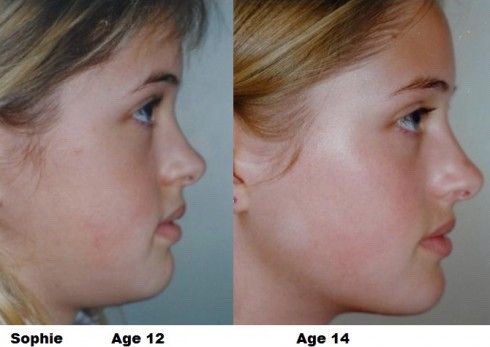 Sophie's 2-year change could be mistaken for surgery.

This transformation was achieved by Professor John Mew, the founding father of mewing.

Orthotropics is a revolutionary alternative to braces and surgery.

Here is how he grows people's jaws naturally: