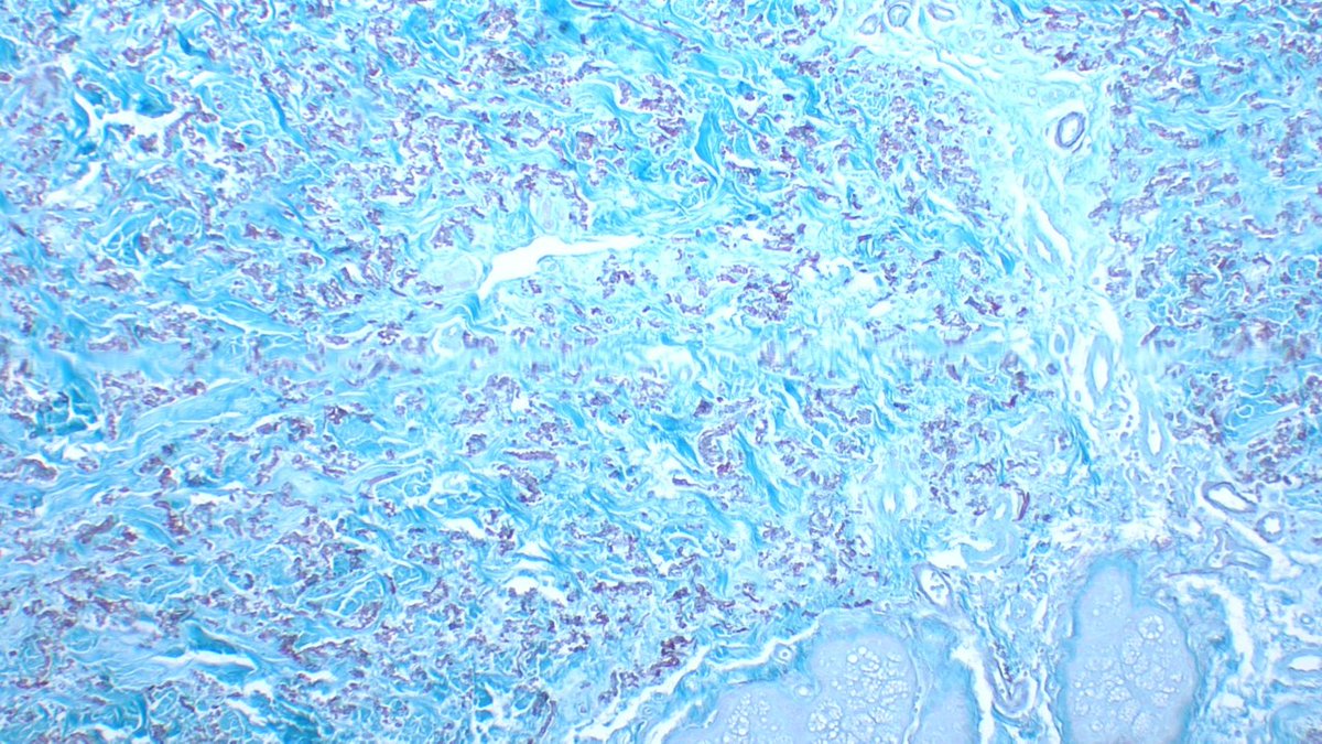 Int Soc Dermpath (@intsocdermpath) on Twitter photo #ISDP #Olympics
Spot diagnosis
Case 10 - <a href="/JCandidoXavier/">Jose Candido</a>
PSEUDOXANTHOMA ELASTICUM
• degenerative disease of elastic tissue
• autosomal dominant
• Elastic fibers are basophilic and irregular, appearing as widely dispersed granular material.
#Path #dermpath #derm #ISDP #Olympics
Spot diagnosis
Case 10 - <a href="/JCandidoXavier/">Jose Candido</a>
PSEUDOXANTHOMA ELASTICUM
• degenerative disease of elastic tissue
• autosomal dominant
• Elastic fibers are basophilic and irregular, appearing as widely dispersed granular material.
#Path #dermpath #derm