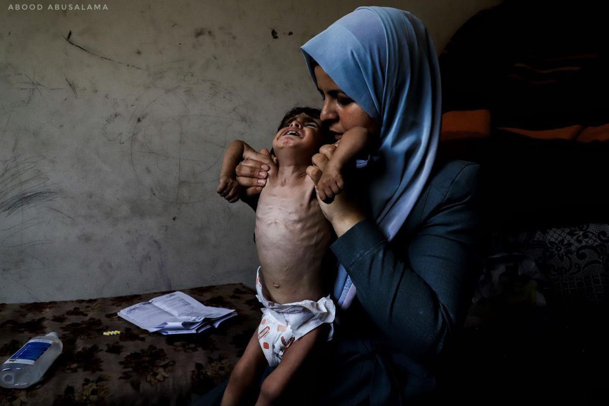 voices_eng's tweet photo. Three-year-old Amjad Al-Qanou from Jabalia, northern Gaza, is suffering from severe malnutrition, weighing only 5 kg. This is due to the shortage of food supplies amid the ongoing Israeli blockade and genocide. https://t.co/WeA4PqNEWV