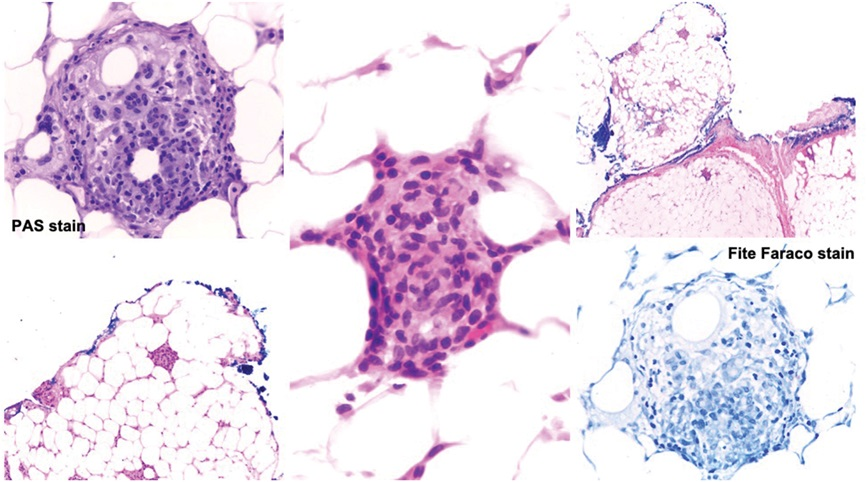 AJDP_Journal's tweet photo. #WhatsNewInDermpath

@MarcelaSaebL 
Granulomatous Panniculitis as an Initial Manifestation of Sjögren Syndrome in a 65F

H/P - focal lobular panniculitis with neutrophilic microgranulomas
https://t.co/Vj5DyBKstE

#dermpath #Sjogren #autoimmunedisease https://t.co/BN214M4MQJ
