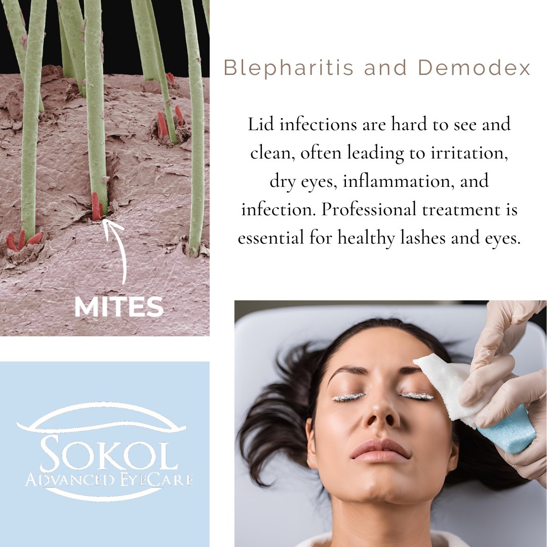 sokoleyecare's tweet image. At-home lash cleanings aren't enough! 🧼✨ Demodex &amp;amp; blepharitis can cause dry eyes. Professional cleaning is crucial, especially between eyelash extensions, to prevent infections. Book our ZEST in-office cleaning for healthy, clean lashes! #EyeHealth #DryEyeRelief #SokolEyecare