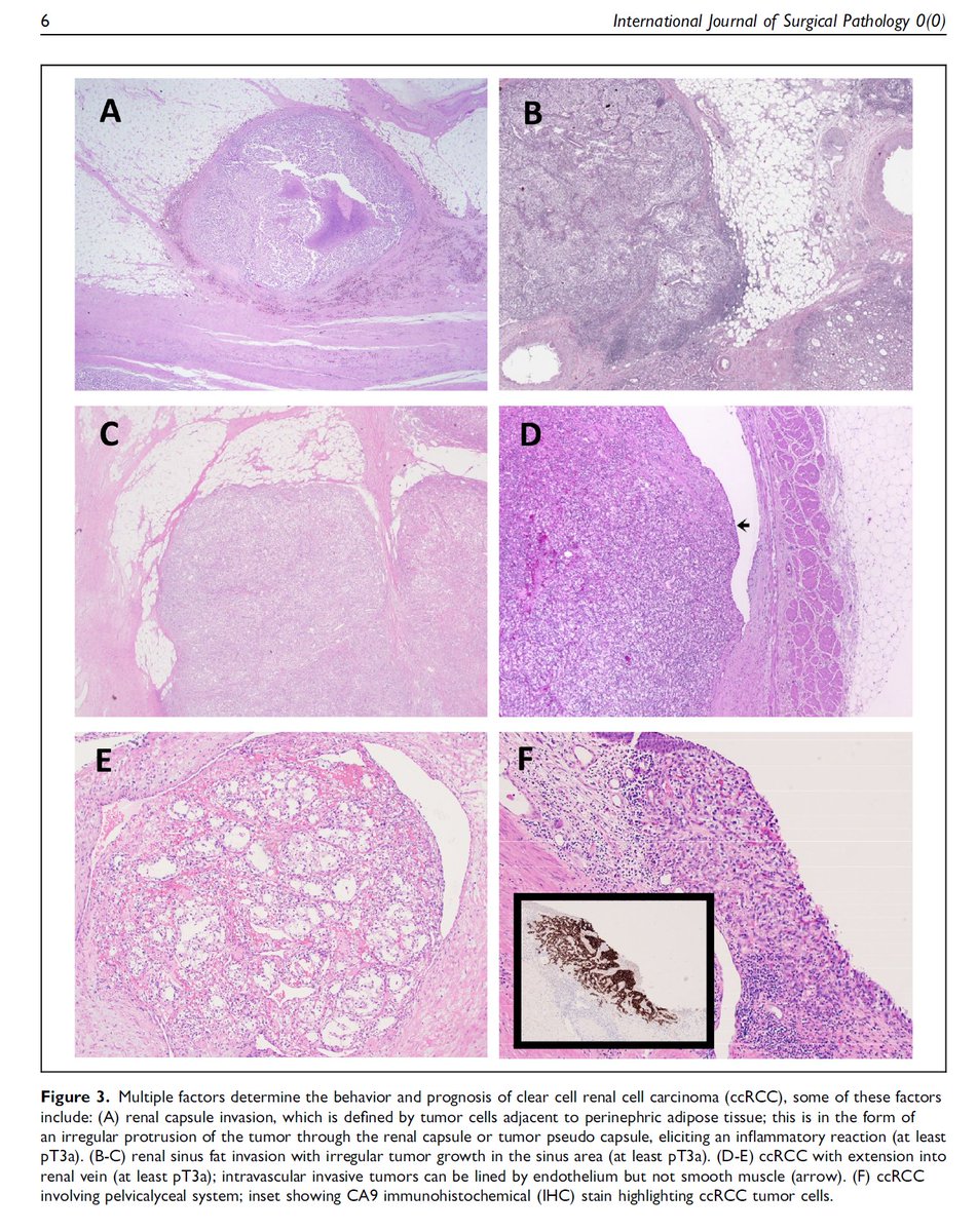 Behtash (@behtashg) on Twitter photo A Comprehensive Review of the Histopathology, Genetics, and Differential Diagnosis of Clear Cell Renal Cell Carcinoma
pubmed.ncbi.nlm.nih.gov/39051572/ A Comprehensive Review of the Histopathology, Genetics, and Differential Diagnosis of Clear Cell Renal Cell Carcinoma
pubmed.ncbi.nlm.nih.gov/39051572/