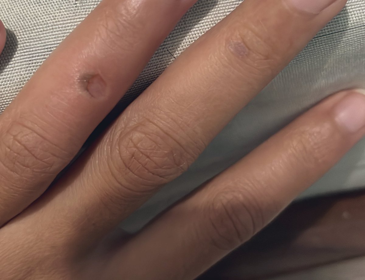 Kena lem tembak tcoyyy 🔫😭
Ketetes trus pas di ambil kulitnya kebawa, jd lah dekok begini tp kek di sundud udud 😔🚬💀