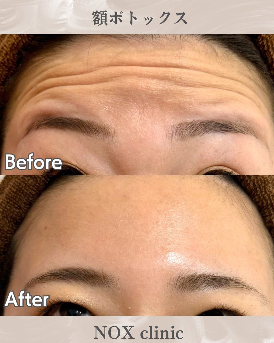 額のボトックスのメリットは
シワがなくなることで
光をキレイに反射するようになり
ツヤのあるおでこを
手に入れることができること✨
自信を持っておでこを出しませんか？？
