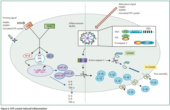 NEW REVIEW—Tristan Pascart and colleagues provide an overview of state of art developments in calcium pyrophosphate deposition disease thelancet.com/journals/lanrh… #OpenAccess #CPPD