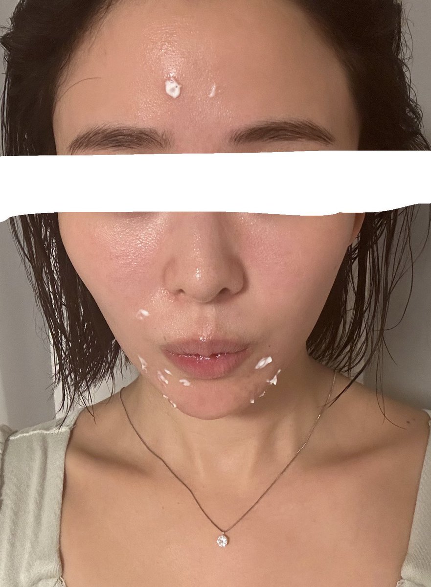 #ポテンツア
して一週間たちました！
肯定反応で肌荒れしてます。

同じ症状にあったことありますか？

#美容垢
#肯定反応
#レーザー