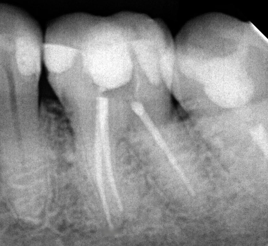 As vezes tira a paz mas muitas vezes nos traz a paz também 😅 post dedicado pra quem ama endodontia ♥️