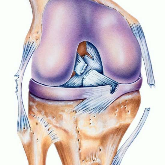 thekneedoc's tweet photo. Why opt for a single-stage multi-ligament reconstruction? Dr. LaPrade’s team explains how this approach can lead to a faster, more effective recovery for combined #ACL and #MCL injuries.https://t.co/C1nVEvA42m #kneehealth #kneeexpert #sportsmedicine https://t.co/4cCYRffDbR