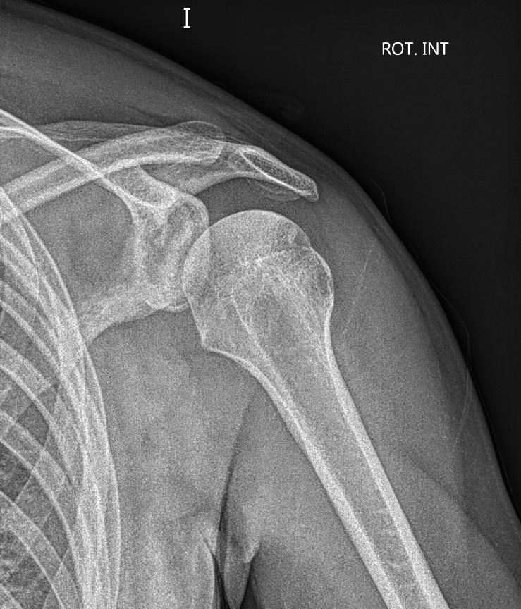 themskarchive's tweet photo. 30/7/2023. 💪 Any impressions on the following XRAY? skier, 27 yo ⚡️💥.
#MSK #shoulder #traumatwitter https://t.co/xeOag1hZun