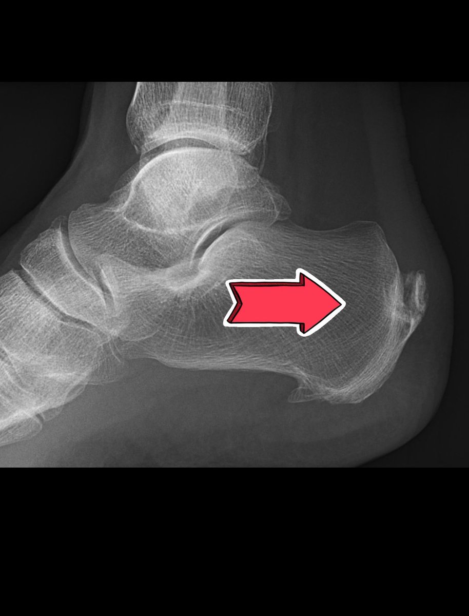 PTosamah's tweet photo. #ثريد عن مشكلة شائعة خاصة عند الرياضين وهو مسمار الكعب (calcaneal spur) عظم يخرج من كعب الرجل بسبب الضغط العالي عليه من وتر الاخيلس . https://t.co/uNwaPrnx4U