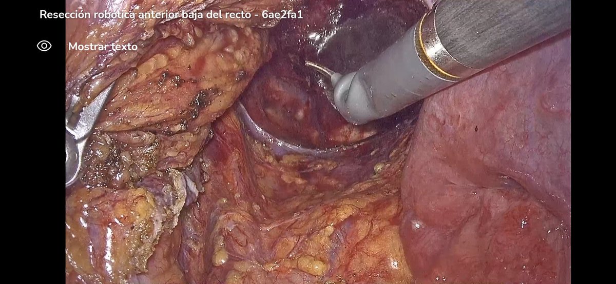 Coloproctología HUMT (@coloproctohumt) on Twitter photo Robotic LAR + high ligation of SMA and SMV with <a href="/MedtronicES/">Medtronic España</a>'s #HugoRAS. Dissection in the deep pelvis has never been so easy! #SoMe4Surgery #robotics Robotic LAR + high ligation of SMA and SMV with <a href="/MedtronicES/">Medtronic España</a>'s #HugoRAS. Dissection in the deep pelvis has never been so easy! #SoMe4Surgery #robotics