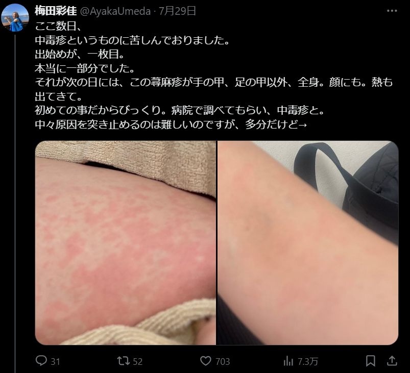 元AKB48の梅田彩佳さん(35) 中毒疹が手の甲、足の甲以外、全身。顔にも。熱も出てきて。 初めての事だからびっくり。 2021年 9月11 ...