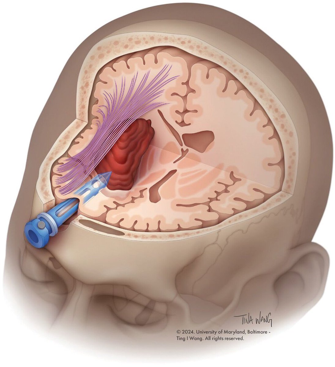 Nicholas Morris (@namorrismd) on Twitter photo There's nothing more exciting right now in #neurocriticalcare than advances in surgical management.  Our review is now published in <a href="/GreenJournal/">Neurology Journal</a> !. <a href="/ChaturvediNeuro/">Seemant Chaturvedi</a> <a href="/MDNeurocritcare/">University of Maryland Neurocritical Care</a> <a href="/umarylandneuro/">Maryland Neurology Residency</a>  <a href="/UMDNeurosurgery/">Maryland Neurosurgery</a> <a href="/AANmember/">American Academy of Neurology</a> <a href="/neurocritical/">Neurocritical Care Society</a> <a href="/caseyalbin/">Casey Albin, MD</a>  neurology.org/doi/10.1212/WN… There's nothing more exciting right now in #neurocriticalcare than advances in surgical management.  Our review is now published in <a href="/GreenJournal/">Neurology Journal</a> !. <a href="/ChaturvediNeuro/">Seemant Chaturvedi</a> <a href="/MDNeurocritcare/">University of Maryland Neurocritical Care</a> <a href="/umarylandneuro/">Maryland Neurology Residency</a>  <a href="/UMDNeurosurgery/">Maryland Neurosurgery</a> <a href="/AANmember/">American Academy of Neurology</a> <a href="/neurocritical/">Neurocritical Care Society</a> <a href="/caseyalbin/">Casey Albin, MD</a>  neurology.org/doi/10.1212/WN…