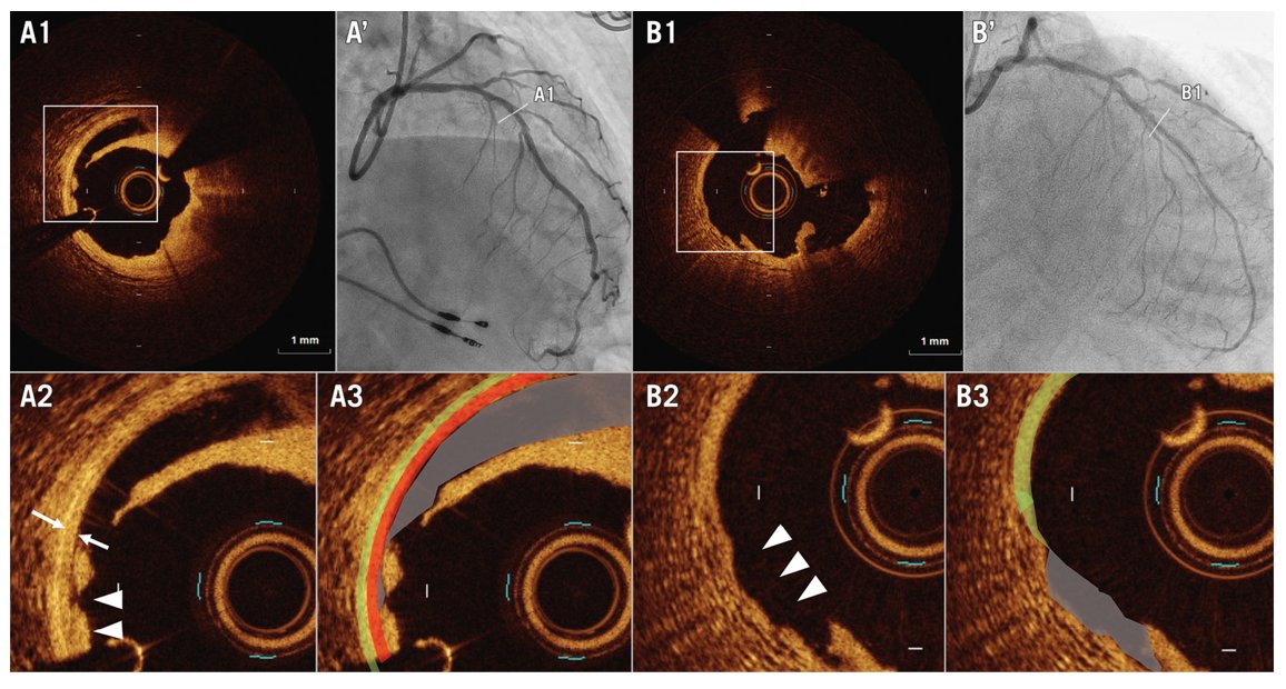 This study identifies key predictors of target lesion failure after drug-coated balloon PCI in de novo coronary lesions: haemodialysis, severe calcification, and the absence of post-PCI medial dissection. Read the full paper 👉ow.ly/S6Ou50SNiZI
