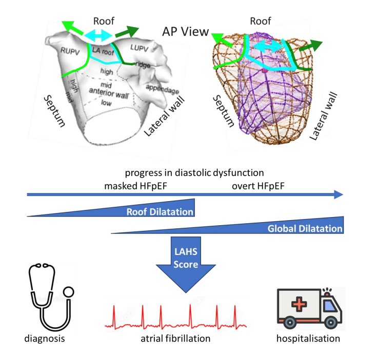 CircImaging (@circimaging) on Twitter photo Left atrial roof enlargement is a distinct feature of HFpEF and predicts atrial fibrillation and cardiovascular hospitalization risk #AHAJournals <a href="/JiwonKimMD/">Jiwon Kim, MD</a> <a href="/kaznegishi/">Kaz Negishi@Cardiologist/ Heart Mafia</a> ahajrnls.org/3AdFPJz Left atrial roof enlargement is a distinct feature of HFpEF and predicts atrial fibrillation and cardiovascular hospitalization risk #AHAJournals <a href="/JiwonKimMD/">Jiwon Kim, MD</a> <a href="/kaznegishi/">Kaz Negishi@Cardiologist/ Heart Mafia</a> ahajrnls.org/3AdFPJz