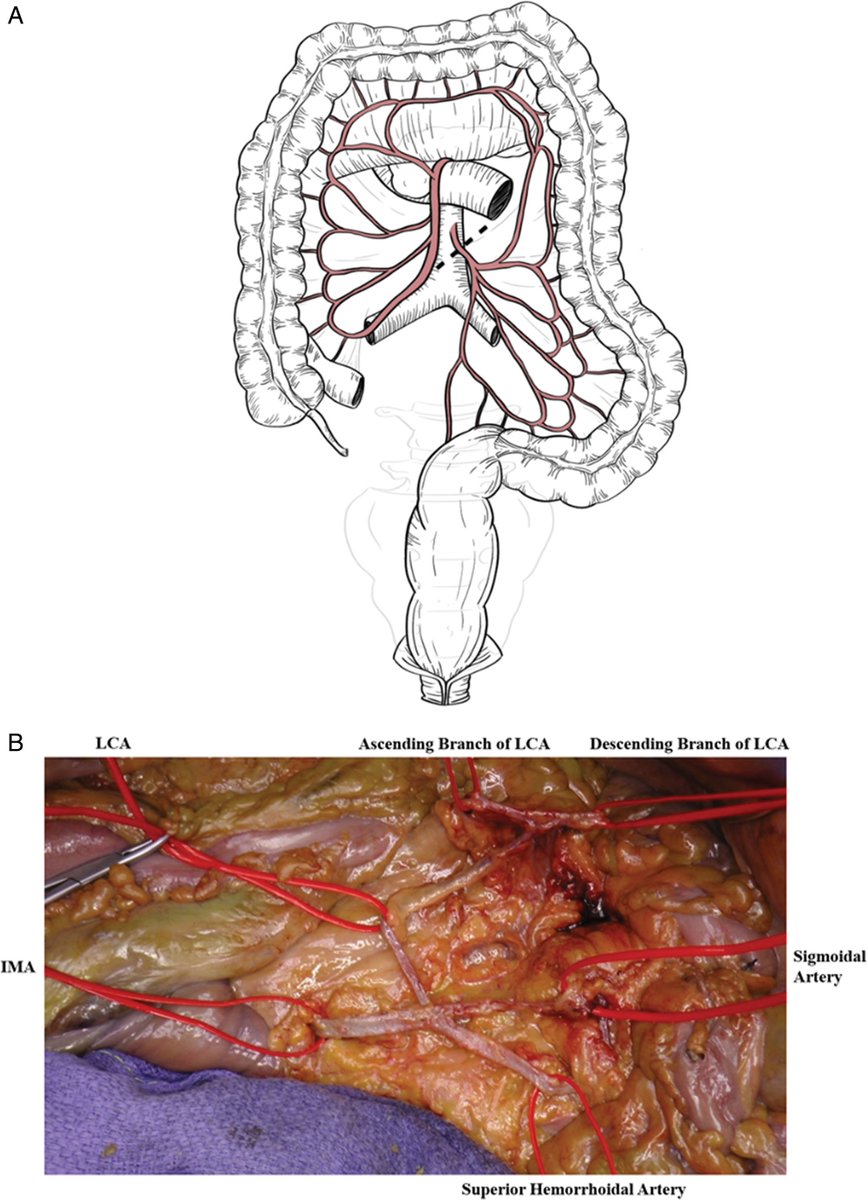 How to create a tension-free anastomosis: how much length in cm does each of 3 colon lengthening maneuvers provide? Find out in this month's #DCRjournal: bit.ly/4bNzeTs

<a href="/JohnRTMonsonMD/">John Monson MD FRCS FACS FASCRS</a> <a href="/jendavidsmd/">Jennifer Davids, MD</a> <a href="/ScottRSteeleMD/">Scott R. Steele</a> @Swexner <a href="/me4_so/">SoMe4Surgery</a> <a href="/ACPGBI/">@ACPGBI</a> <a href="/drtracyhull/">Tracy Hull</a> <a href="/ASCRS_1/">ASCRS_1</a>