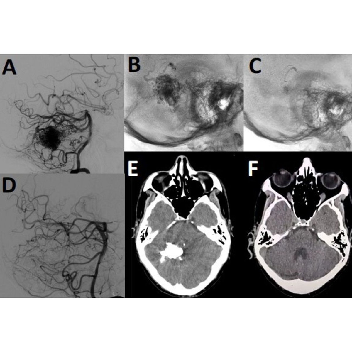 A novel liquid embolic with decreased radio-opacity over time! Llibre-Guerra et al. present the results of the CLARIDAD trial bit.ly/4fmduB8 describing the use of this embolic in AVMS, DAVFs and tumor embolization. #embolization #INR