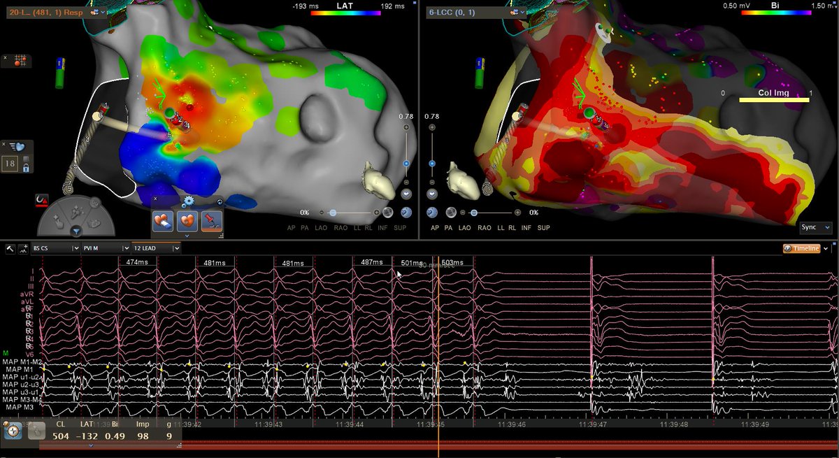 inHEART (@inheartmedical) on Twitter photo Integrating a Late Iodine Enhanced CT allows the identification of critical sites pre-procedurally. The result is focused, expeditious mapping, and confidence in the outcome.
Beautiful maps and case by <a href="/EOG_MD/">Edmond Obeng-Gyimah, MD FACC, FHRS</a>, <a href="/WenckebachShock/">Campbell Messner</a> of #BiosenseWebster, and strong work by the team Integrating a Late Iodine Enhanced CT allows the identification of critical sites pre-procedurally. The result is focused, expeditious mapping, and confidence in the outcome.
Beautiful maps and case by <a href="/EOG_MD/">Edmond Obeng-Gyimah, MD FACC, FHRS</a>, <a href="/WenckebachShock/">Campbell Messner</a> of #BiosenseWebster, and strong work by the team