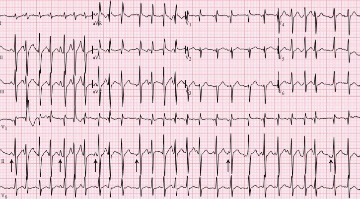 walinjom's tweet image. Ecg Spot Diagnosis 
Case 12 

76 yrs M with COPD presents with Palpitations. 

1. Diagnosis?
2. Will you anticoagulate or Not ?