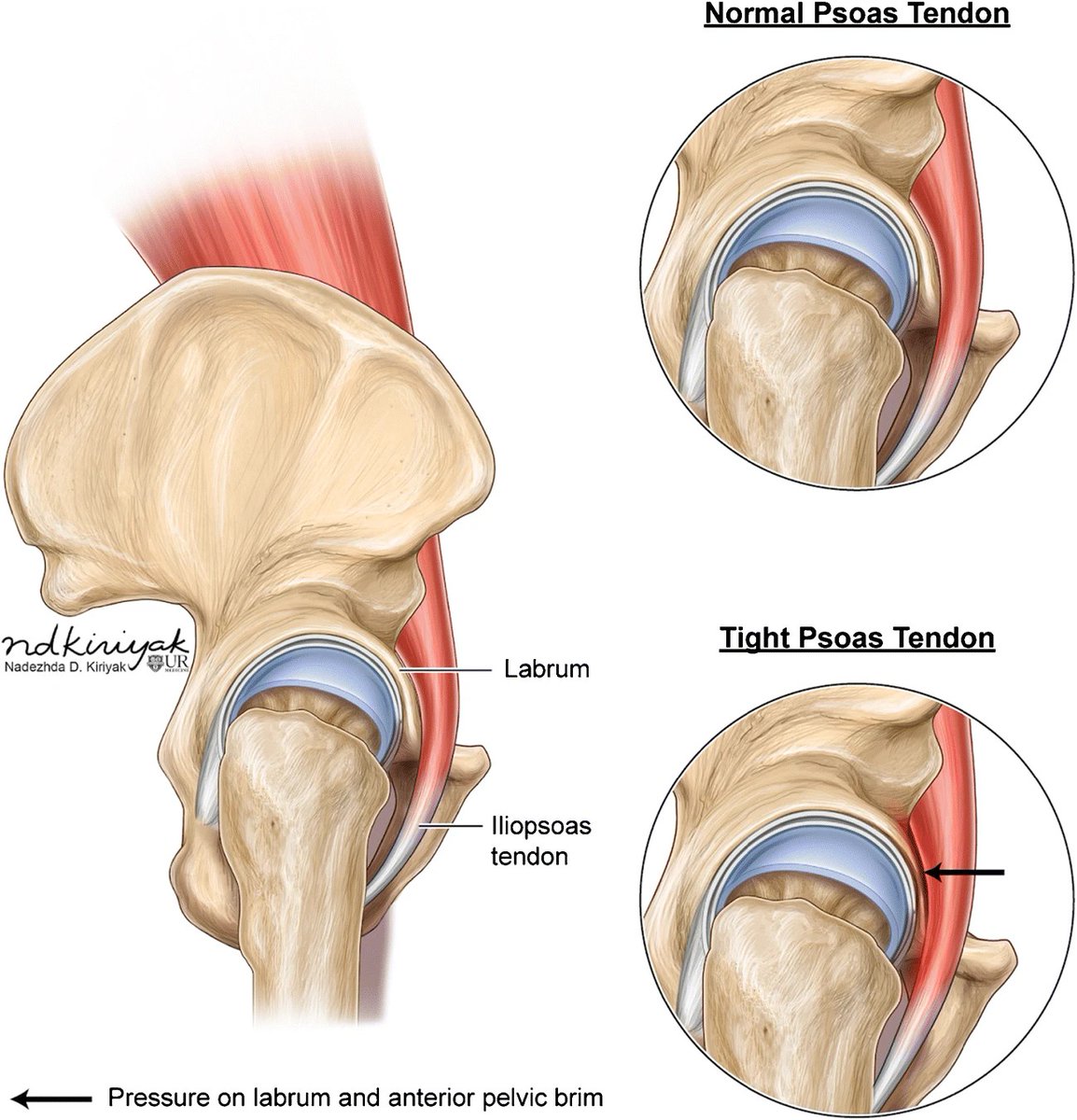 Iliopsoas snapping hip

pubmed.ncbi.nlm.nih.gov/30280202/