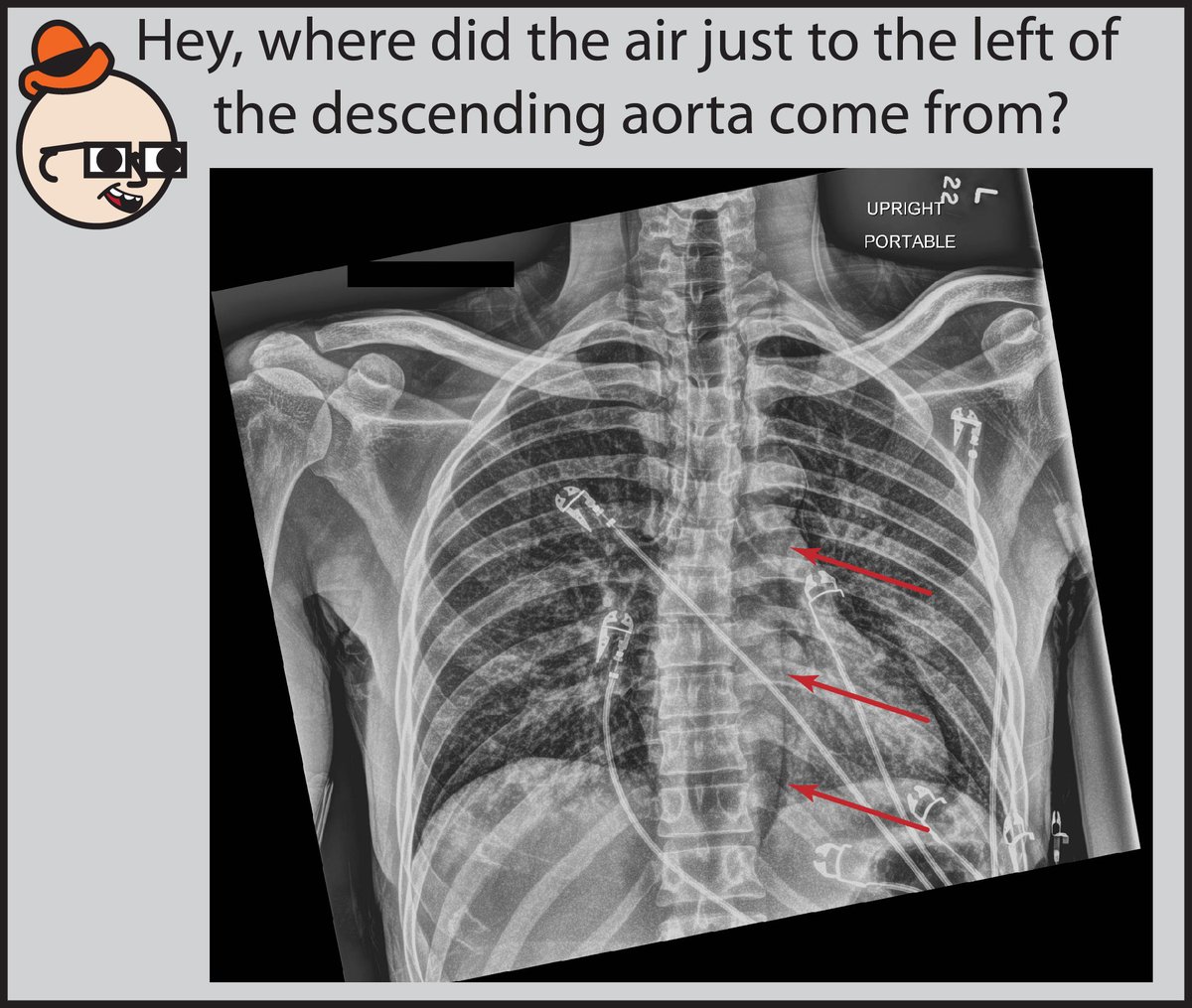 StefanTigges's tweet photo. Why does this person have air in the mediastinum? If you’d like to learn how to read chest X-Rays, check out my comic: https://t.co/xhAMW41QCh https://t.co/IR6SvTKDT6