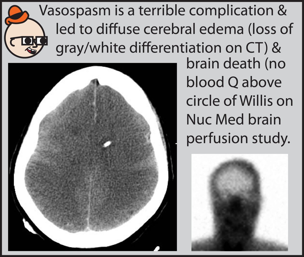 Can you determine how likely it is that someone with subarachnoid hemorrhage will develop vasospasm? If you’d like to learn how to read head CTs, check out our free comic: radiopaedia.org/courses/head-c…