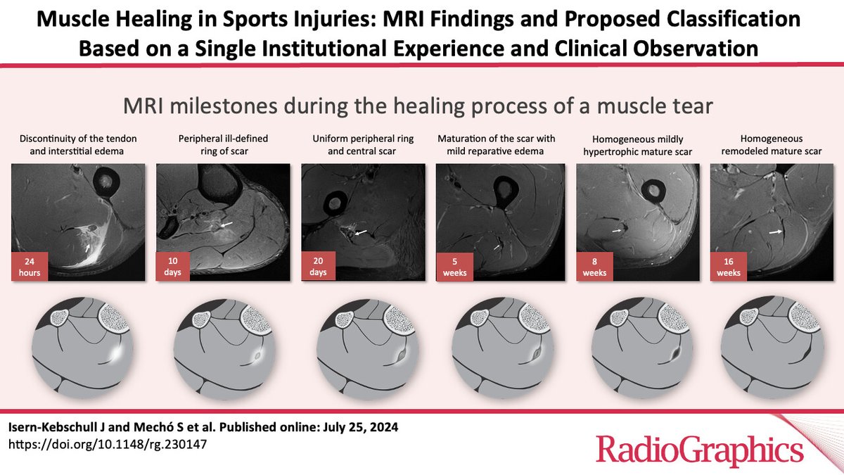 Radiologia MSK - Hospital Clínic Barcelona (@mskradhcb) on Twitter photo 🚨 Don't miss the latest work by our team members <a href="/IsernKebschull/">Jaime Isern Kebschull</a> and <a href="/gadolinio61/">Gadolinio61 Dr. Xavier TOMAS BATLLE</a> on muscle injury healing! 🏋️♂️💪 A must-read for all sports medicine enthusiasts 📚🔥 #SportsMedicine #HealingProcess #MSKrad
pubs.rsna.org/doi/10.1148/rg… 🚨 Don't miss the latest work by our team members <a href="/IsernKebschull/">Jaime Isern Kebschull</a> and <a href="/gadolinio61/">Gadolinio61 Dr. Xavier TOMAS BATLLE</a> on muscle injury healing! 🏋️♂️💪 A must-read for all sports medicine enthusiasts 📚🔥 #SportsMedicine #HealingProcess #MSKrad
pubs.rsna.org/doi/10.1148/rg…