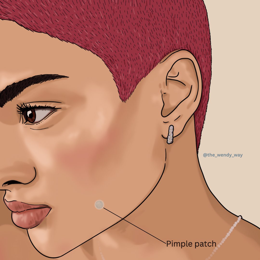 SavingFaceSpa's tweet photo. Tempted to pick that pimple? 🚫🤚 
Picking a pimple causes trauma to your skin, leading to inflammation, potential scarring, and even infection. 

#thewendyway #pimplepatches #skincaretips https://t.co/FaU2kv89Jy