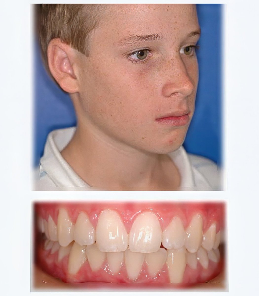 JohnFlutter's tweet image. We grew this boy's jaws without surgery in 18 months.
He came to us with severe crooked teeth, a weak chin and incompetent lips.
So we trained him to correct his oral posture using the Myobrace system.
As a result, his teeth naturally aligned and his facial structure improved.…