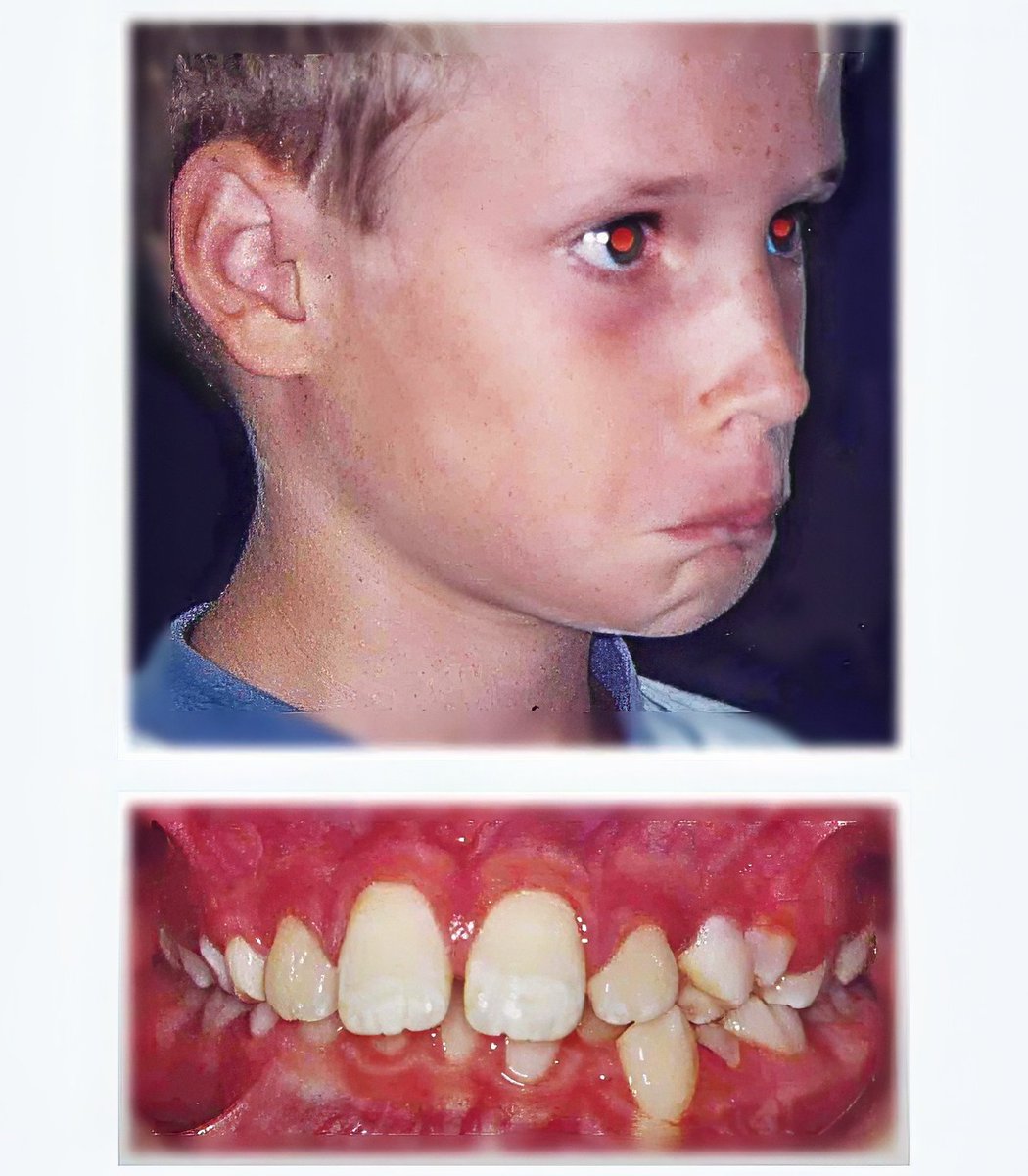 JohnFlutter's tweet image. We grew this boy's jaws without surgery in 18 months.
He came to us with severe crooked teeth, a weak chin and incompetent lips.
So we trained him to correct his oral posture using the Myobrace system.
As a result, his teeth naturally aligned and his facial structure improved.…