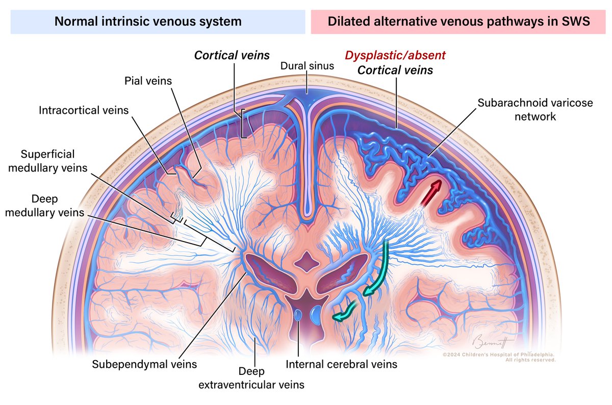 Amirreza Manteghinejad (@armanten) on Twitter photo Happy to share our newly published paper at <a href="/TheAJNR/">AJNR</a> on the early diagnosis of Sturge–Weber syndrome using imaging features of alternative venous pathways.
Here is the link to the full-text:
ajnr.org/content/early/…
<a href="/CHOPRadiology/">CHOP Radiology</a> <a href="/crcerron/">Carmen Cerron-Vela</a> Happy to share our newly published paper at <a href="/TheAJNR/">AJNR</a> on the early diagnosis of Sturge–Weber syndrome using imaging features of alternative venous pathways.
Here is the link to the full-text:
ajnr.org/content/early/…
<a href="/CHOPRadiology/">CHOP Radiology</a> <a href="/crcerron/">Carmen Cerron-Vela</a>