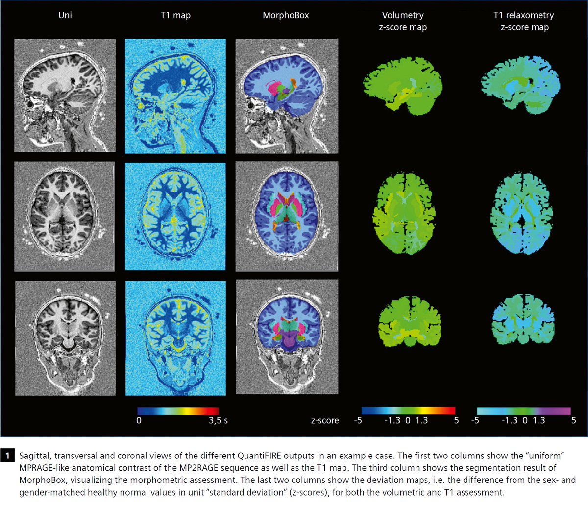 MP2RAGE-based Inline Morphometric and Regional T1 Assessment in #Pediatric Patients by Prof. Baptiste  Morel, et al. Learn about a single MP2RAGE acquisition that provides anatomical information for #morphometry, and quantitative T1 maps at …ng.webassets.siemens-healthineers.com/a13df1472bfd13…
#magnetomworld