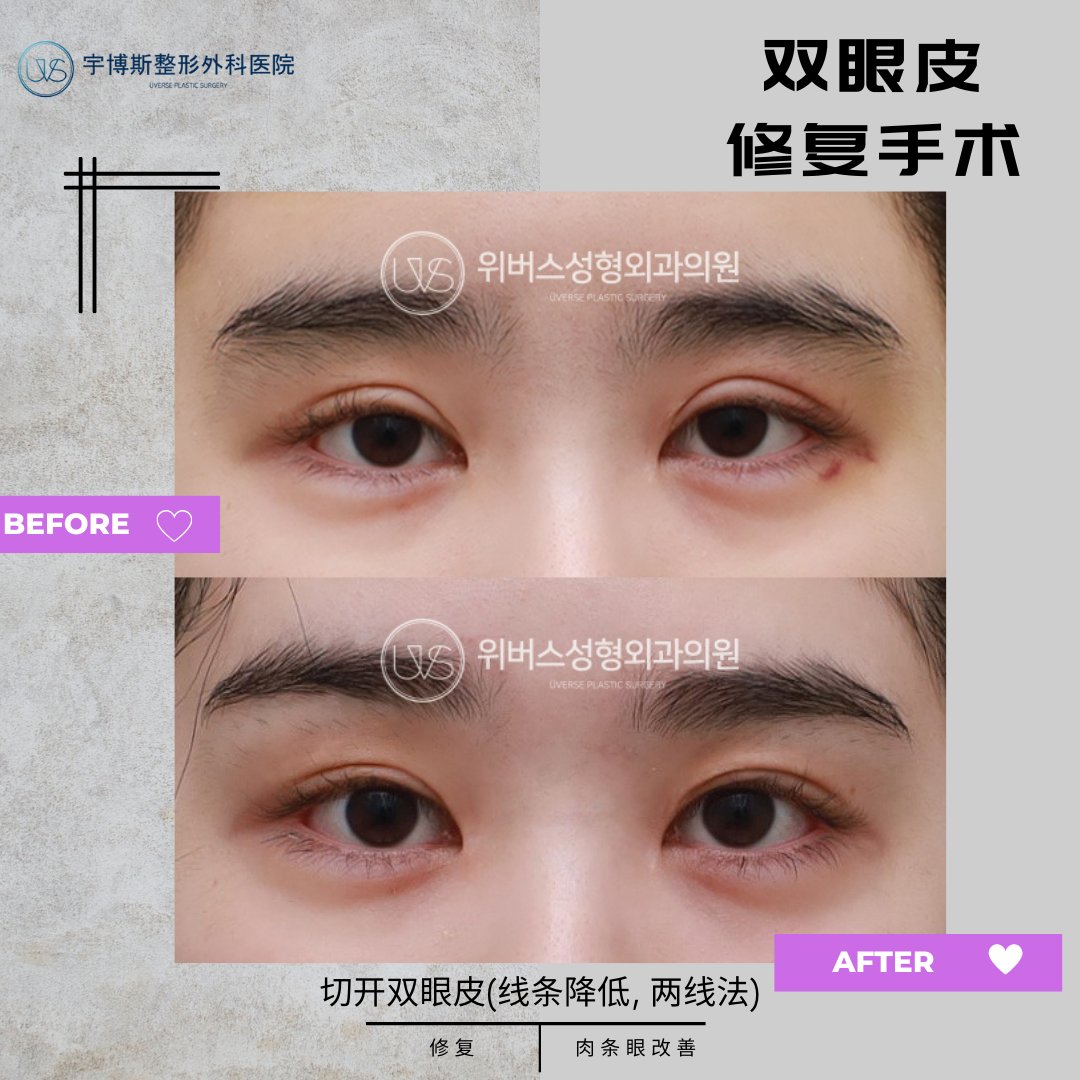 雙眼皮重修、開眼角、眼袋手術等等…… 想讓眼睛更明就有神但不知道哪裡才是眼整形首選嗎？ 誠意推薦韓國TOBE整形外科🙂 韓國TOBE整形外科, image size:1080x1080