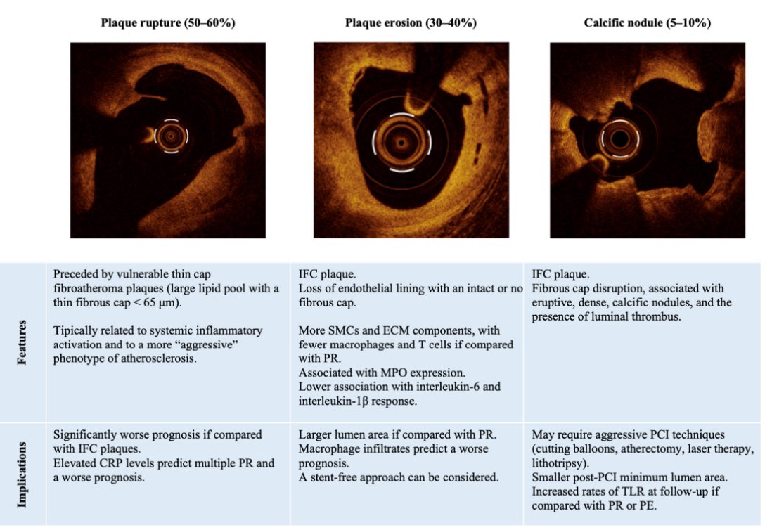 Medicina de Precisión en síndromes coronarios agudos: saber que le pasa a la placa, dar el tratamiento adecuado con o sin atc, dar el tratamiento adecuado por el tiempo adecuado! Vamos en esa dirección ! mdpi.com/2077-0383/13/1…