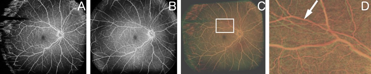 revoptom's tweet image. Widefield OCT-A Shows Promise in Early Detection of Post-Surgical Changes in RRD Patients

Study highlights ability to identify subtle retinal vessel alterations that may foreshadow recurrence of detachment.
reviewofoptometry.com/article/widefi…
#retina #retinaldetachment #optometry #eyecare