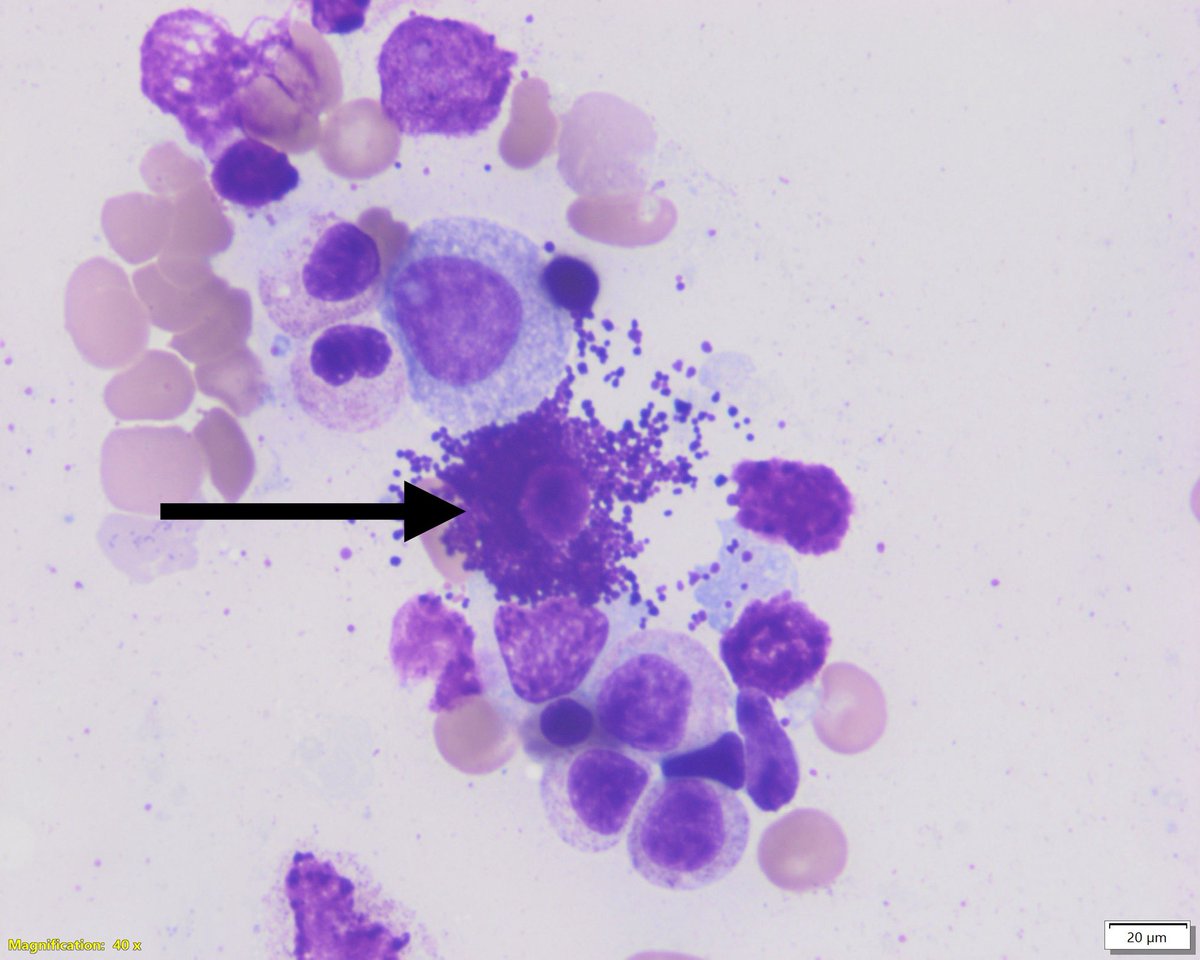 This mast cell.. very casually releasing its gorgeous granules on the surrounding dysplastic granulocytes
I think it’s trying to fight the MDS… 🥷 or maybe it’s just pretending to be good 😈
#hemepath #MDSSM