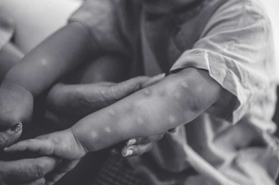 AHFcares's tweet photo. We praise the #AfricaCDC for its strong leadership in declaring #Mpox a public health emergency of continental security and working to secure millions of #vaccines to mitigate the spread. This declaration underscores the urgent need for coordinated efforts to tackle the increasing threat of the Mpox virus across Africa.

https://t.co/usDhsWpEsD