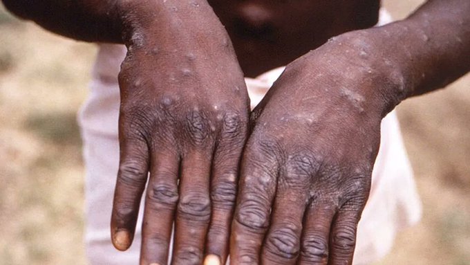 Estos son los efectos en el cuerpo humano de la viruela del mono. Esperemos no llegue a Am&eacute;rica. #ViruelaDelMono<a href="/tag/virueladelmono"class="tags"><span>#virueladelmono</span></a>