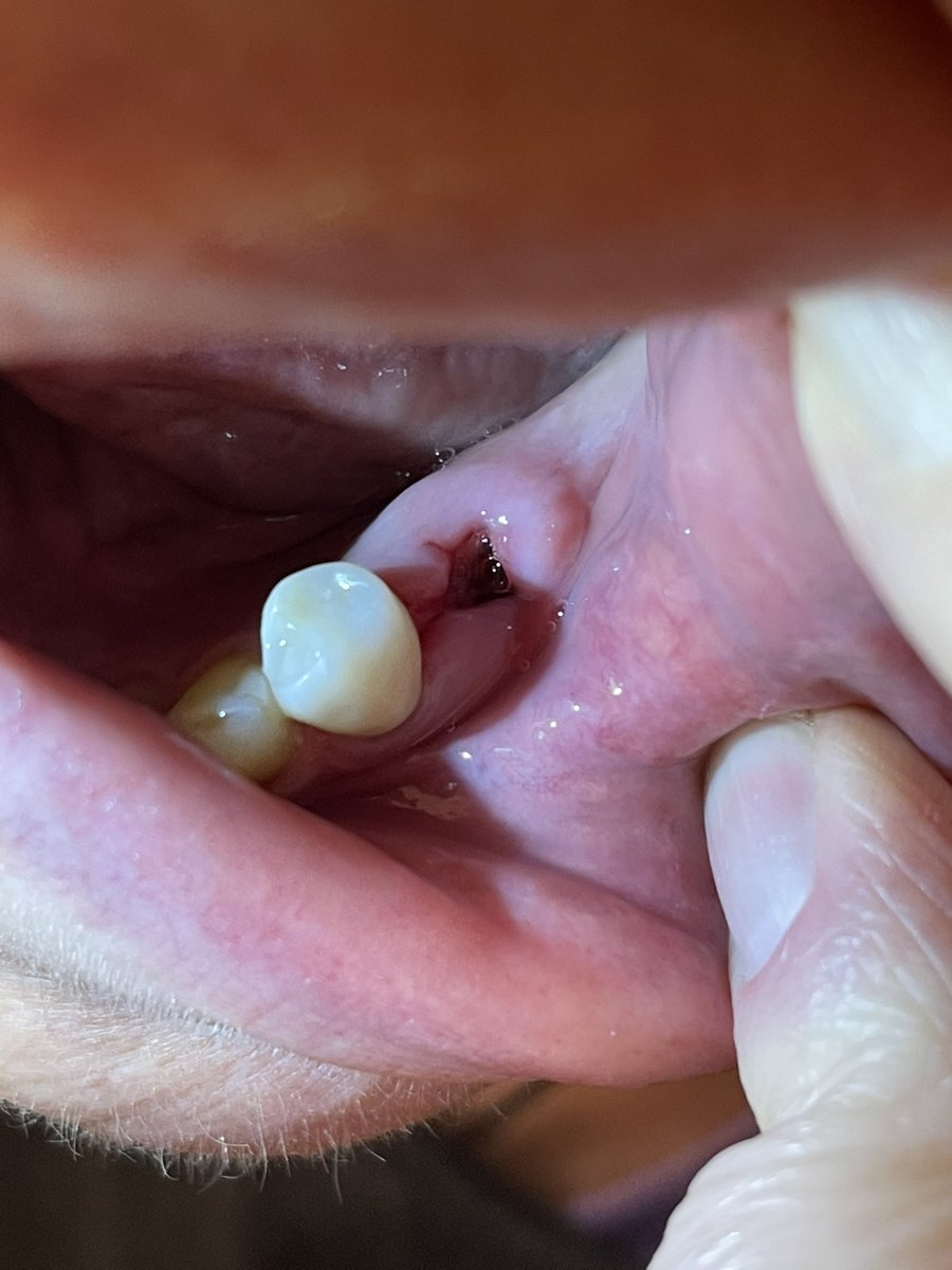 Cindeli's tweet photo. @pulte I am missing 6 teeth. This is the latest extraction.  I have no molars left!  I would like to be able to chew without pain &amp; smile again.  This would be a wonderful gift &amp; a blessing.  Thank you so much for your kindness &amp; generosity Mr. Pulte 🙏🏻  $Cinndella https://t.co/pkokei28iH