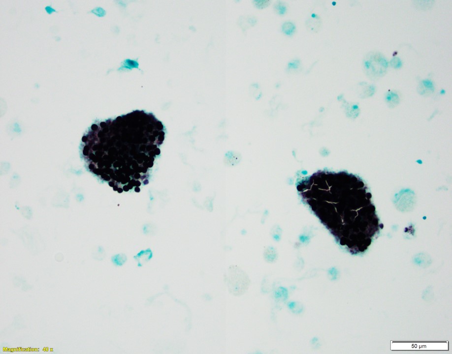 UABPathology's tweet photo. This week's #UABCyto case from Dr. Caroline Stanek: An immunocompromised patient receives a stat bronchoalveolar lavage with GMS-positive ‘crushed ping-pong ball’ organisms without budding, consistent with Pneumocystis jirovecii. https://t.co/mVeq2XebTZ
