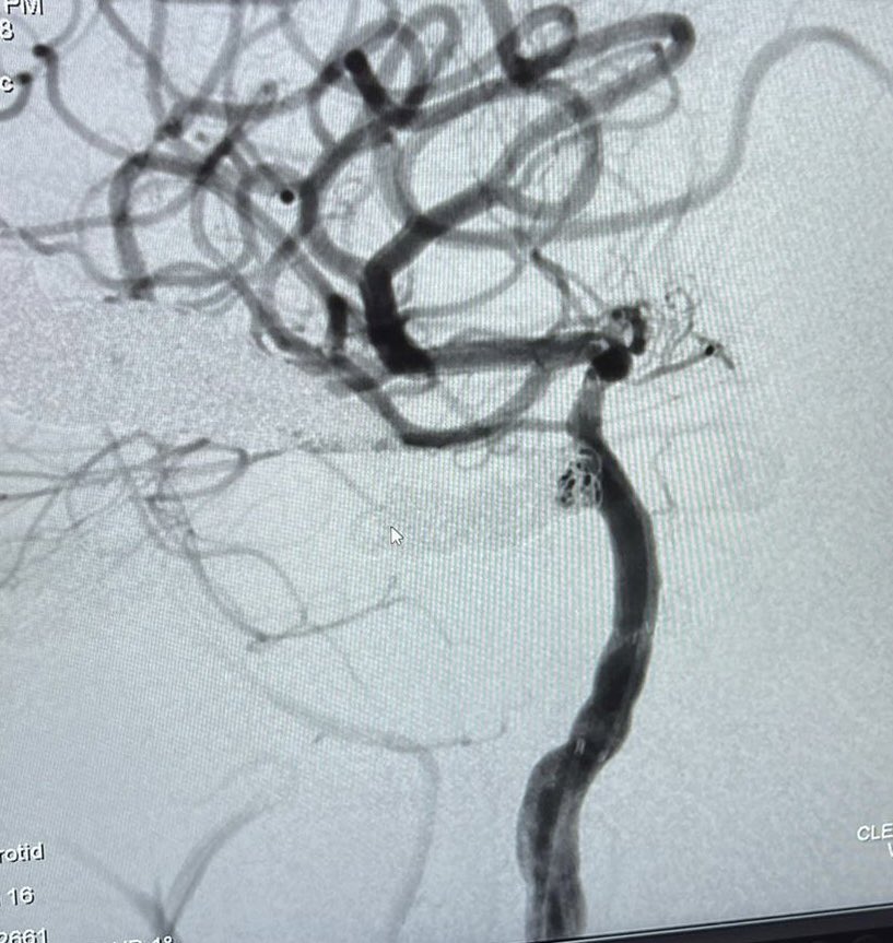 We successfully inserted endovascular coils in a pt with carotid cavernous fistula at <a href="/MuhimbiliOrtho1/">Muhimbili Orthopaedic Institute(MOI)</a> with the NeuroIntervention teams led by Drs. <a href="/faheem_sheriff/">Faheem Sheriff</a> <a href="/karolbudohoski/">Karol Budohoski</a> 
as we bridge our way to establishing capacity for neurovascular interventions in Tanzania!