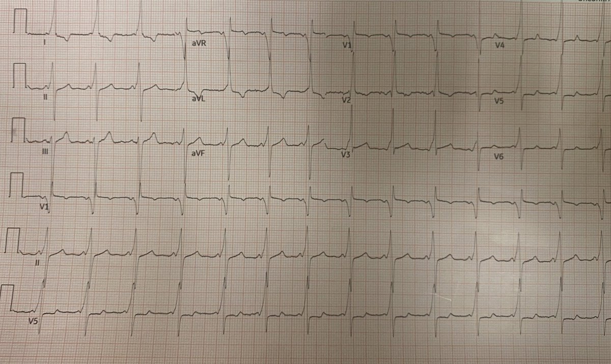 carunnarayanan's tweet photo. 25 yo M with witnessed syncope. AF with AP conduction with degeneration to VF arrest requiring AED shock. Right posteroseptal AP successfully ablated with loss of preexcitation. VF arrest as first presentation of WPW. 
@utmbcardiology  @deansabayon @HaiderTaii @docHJ #EPpeeps https://t.co/AMHPcce4rb
