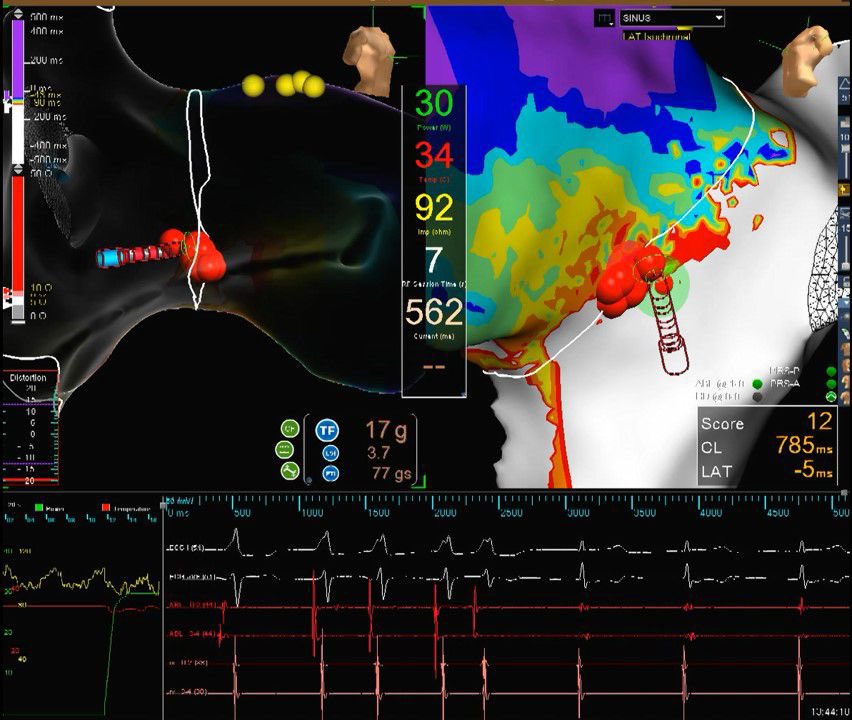 carunnarayanan's tweet photo. 25 yo M with witnessed syncope. AF with AP conduction with degeneration to VF arrest requiring AED shock. Right posteroseptal AP successfully ablated with loss of preexcitation. VF arrest as first presentation of WPW. 
@utmbcardiology  @deansabayon @HaiderTaii @docHJ #EPpeeps https://t.co/AMHPcce4rb