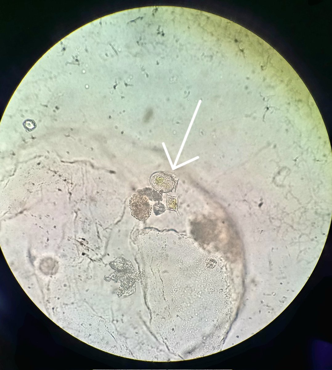 lamic_ufpr's tweet photo. Not rarely in Southern Brazil, Noctiluca preys upon cells of harmful algae like #Dinophysis, becoming a vector of their diarrhetic #shellfish #toxins to #marine #food webs and #seafood consumers. https://t.co/9AOwRD8Thm