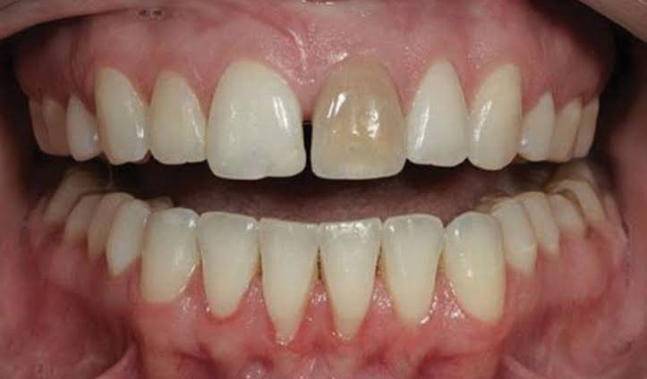 toothfairy06's tweet photo. CARI PASIEN PSA🦷👩🏻‍⚕️

Bagi kalian yang memiliki kondisi:
- gigi depan berubah warna kehitaman
- gigi depan berlubang parah / besar
- gigi depan patah karena kecelakaan / jatuh

dan mau dirawat gratis oleh dokter gigi muda, boleh dm aku ya🤍

t: perawatan gigi gratis, patah, hitam https://t.co/M7ER8hSZai
