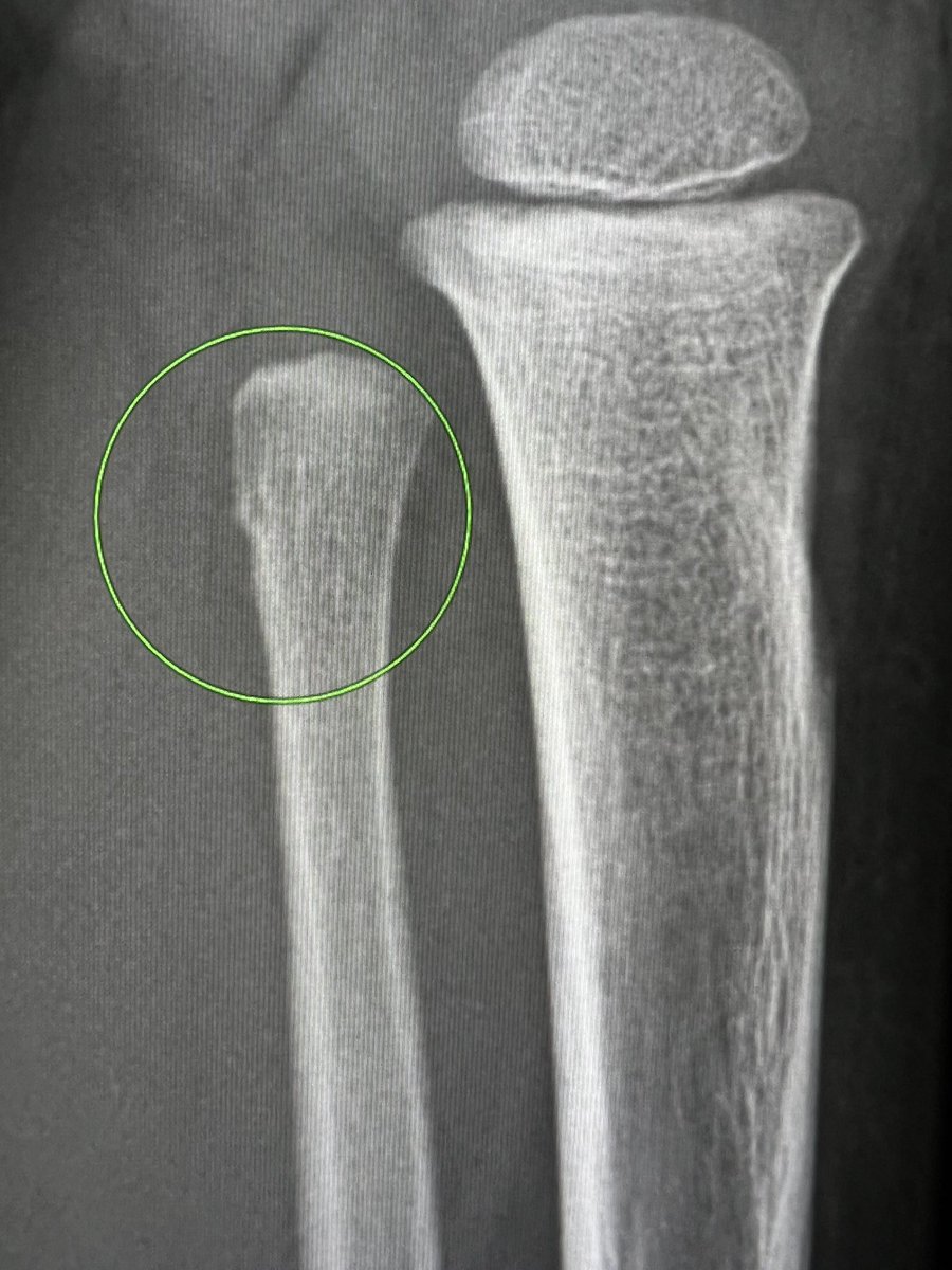 samrad77's tweet photo. Buckling of Tibia and fibula. Very rare. 

—on-call cases https://t.co/ZYJ55g36tv