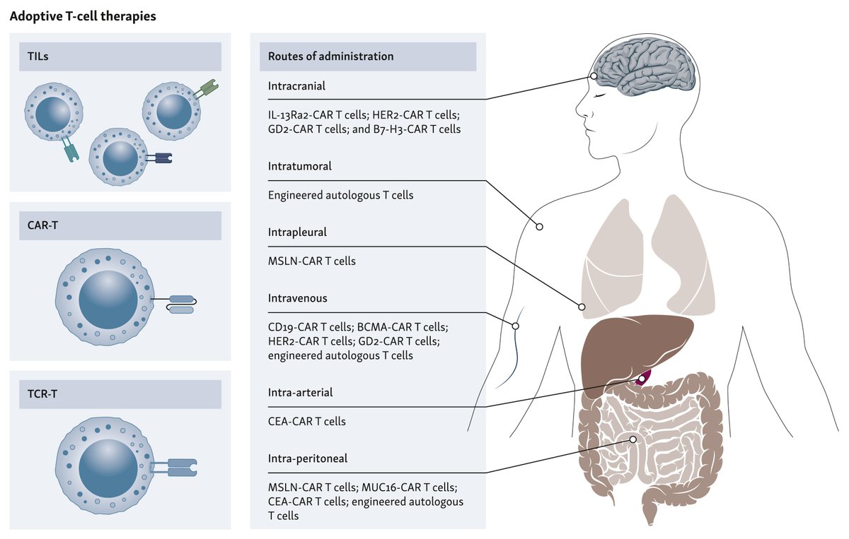ESMO IOTECH (@esmo_iotech) on Twitter photo 🔖 Latest REVIEW by Olivera & <a href="/DrIgMelero/">Ignacio Melero</a> + colleagues on 'Regional and intratumoral adoptive T-cell therapy'.
Available #OpenAccess 👇
esmoiotech.org/article/S2590-… 🔖 Latest REVIEW by Olivera & <a href="/DrIgMelero/">Ignacio Melero</a> + colleagues on 'Regional and intratumoral adoptive T-cell therapy'.
Available #OpenAccess 👇
esmoiotech.org/article/S2590-…