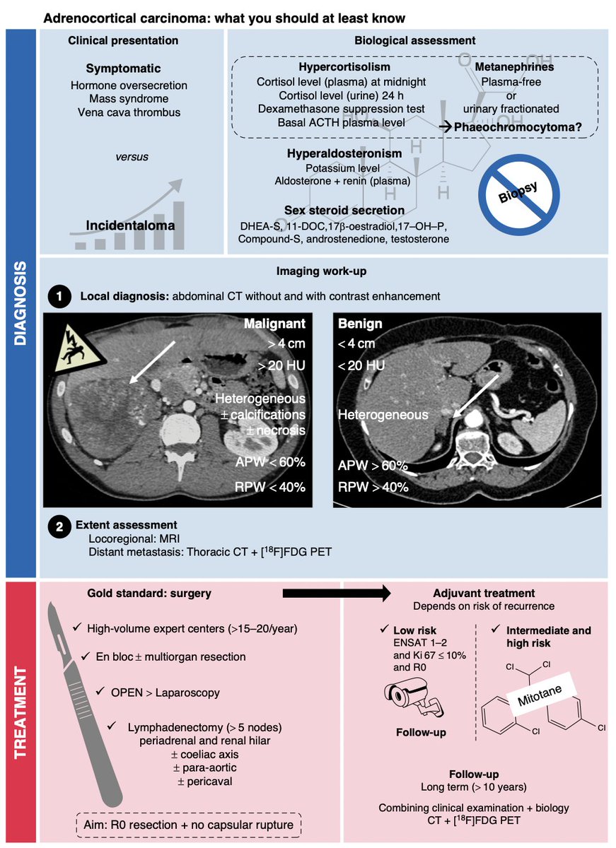 BJSurgery's tweet image. Read @young_bjs 'Acute threat to Life' series! 
7⃣Adrenocortical carcinoma: what you at least should know
doi.org/10.1093/bjs/zn…

Adrenocortical carcinoma (ACC) is rare, with an incidence of 0.5–2 per million per year. 
ACC usually occurs in the fifth or sixth decade with a…