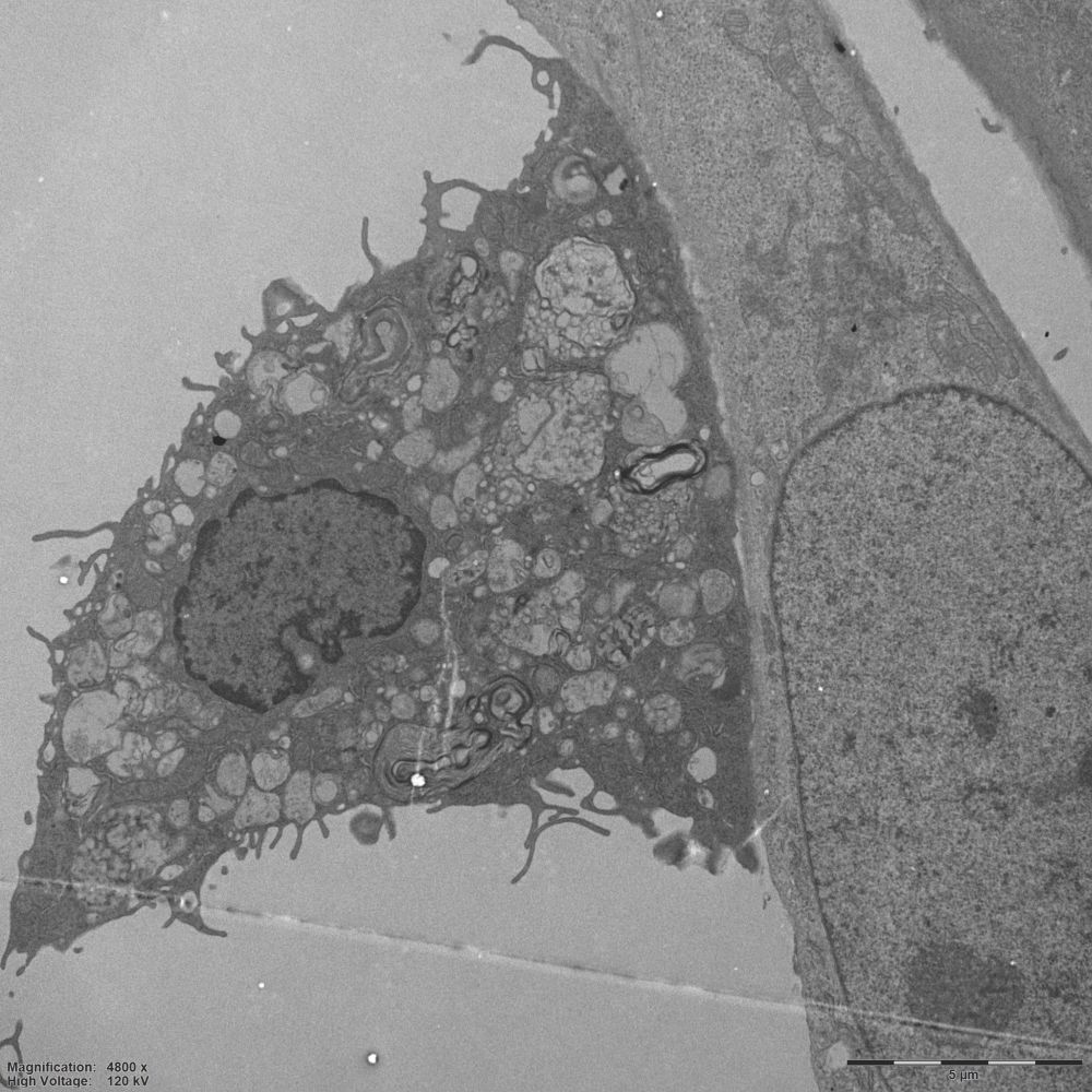 The Netherlands Cancer Institute (@nki_nl) on Twitter photo Research from <a href="/LeilaAkkari/">leila akkari</a>'s research group shows that white blood cells loaded with cholesterol play a critical role in the growth of #glioblastoma. These fat-laden macrophages influence the local immune response and help the tumor survive. Read more ➡️ bit.ly/3SNqMwZ Research from <a href="/LeilaAkkari/">leila akkari</a>'s research group shows that white blood cells loaded with cholesterol play a critical role in the growth of #glioblastoma. These fat-laden macrophages influence the local immune response and help the tumor survive. Read more ➡️ bit.ly/3SNqMwZ