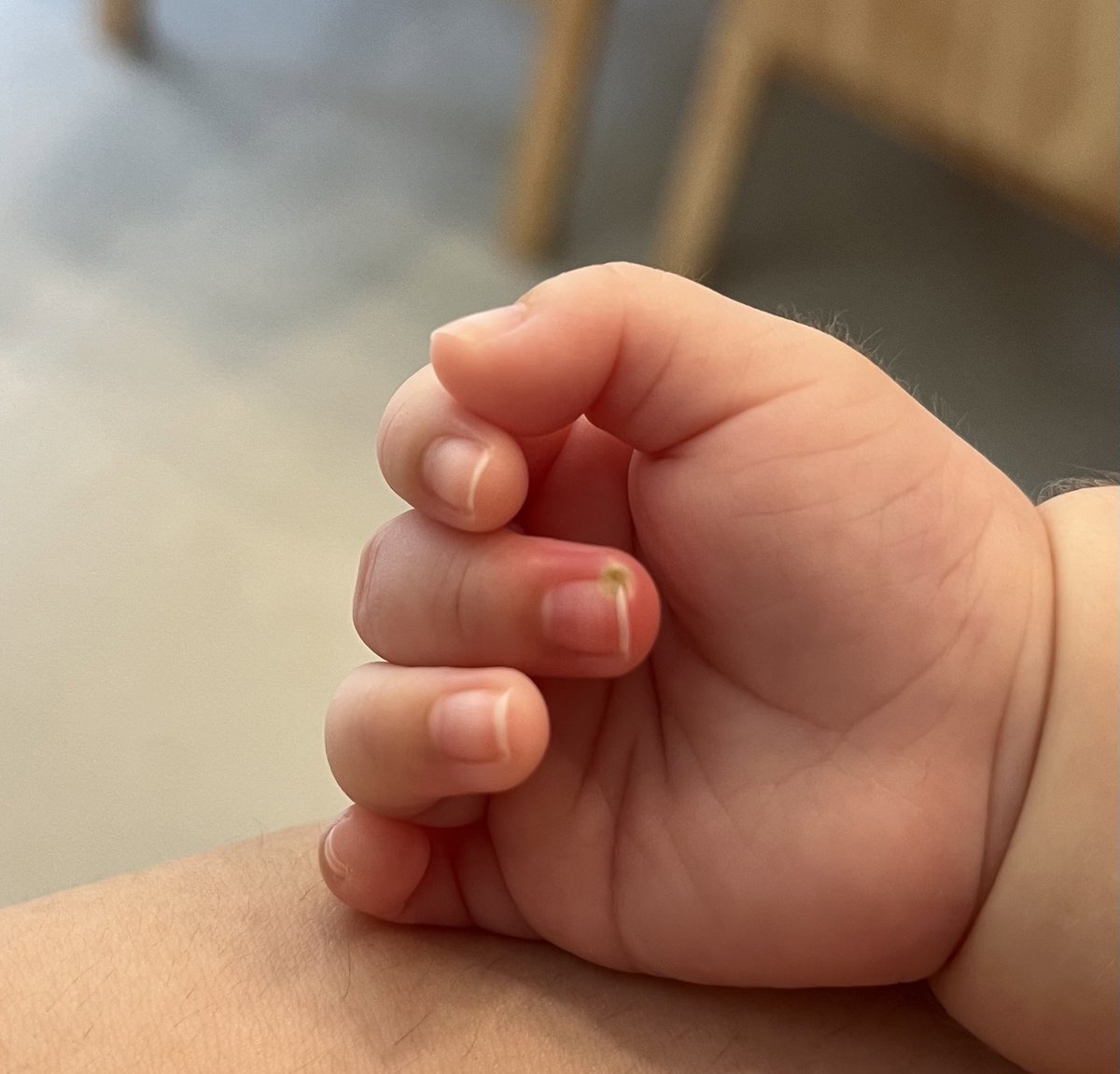 Rvkq1214's tweet photo. 1ヶ月の娘。授乳中に中指が膿んでいることに気づいた…。地元の総合病院の救急外来に来たんだけど、医師が1名しか居ないらしく何時間待つか待ち時間わからないらしい。
金曜日まで待ってかかりつけの小児科に行くか、このままいつまでかかるかわからないが待ち続けるか。
#拡散希望　#アドバイス下さい https://t.co/19GR4PVMOw